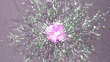 Microscopic image of ovarian cancer cells